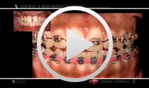 Esthetic and Restorative Dentistry - Ceramic Materials