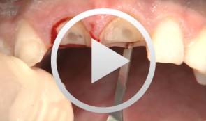 Socket-shield surgery on two central incisors