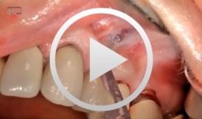 Microsurgical apical resection on a maxillary premolar