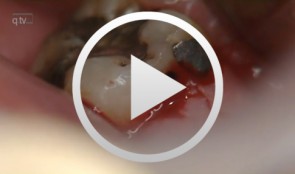 Implantation im unteren Seitenzahnbereich und sofortige provisorische Versorgung