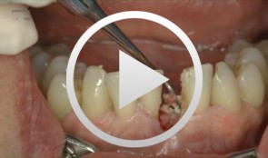 Restoring a mandibular anterior single-tooth gap with an implant-supported crown