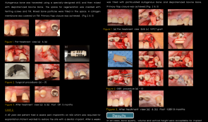 VERTICAL AND HORIZONTAL RIDGE AUGMENTATION USING TITANIUM MESH AND AUTOGENOUS BLOCK BONE