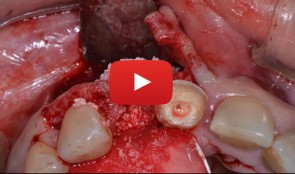 Treatment of a fenestration defect with GBR and CT graft